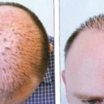 hair transplant