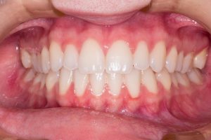 clean teeth