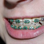 dental braces