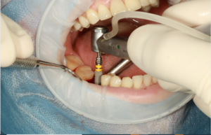 dental implant offer permanent restoration