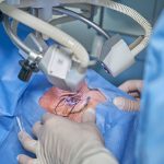 eye laser surgery
